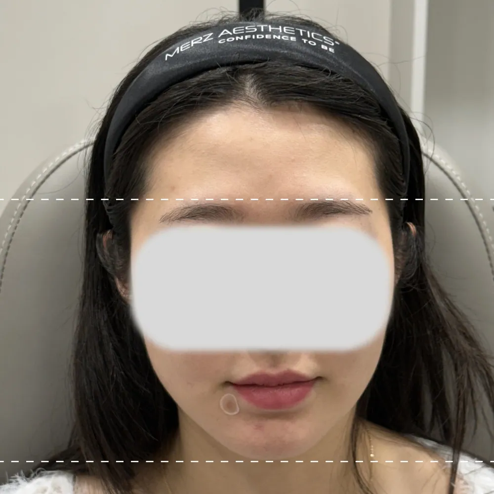 이마필러 정면 시술 전