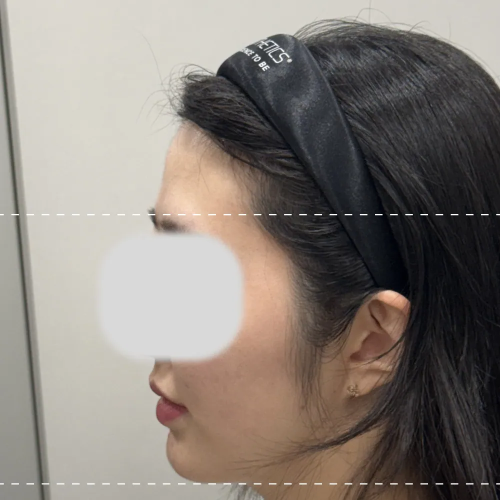 이마필러 왼쪽 90도 시술 전