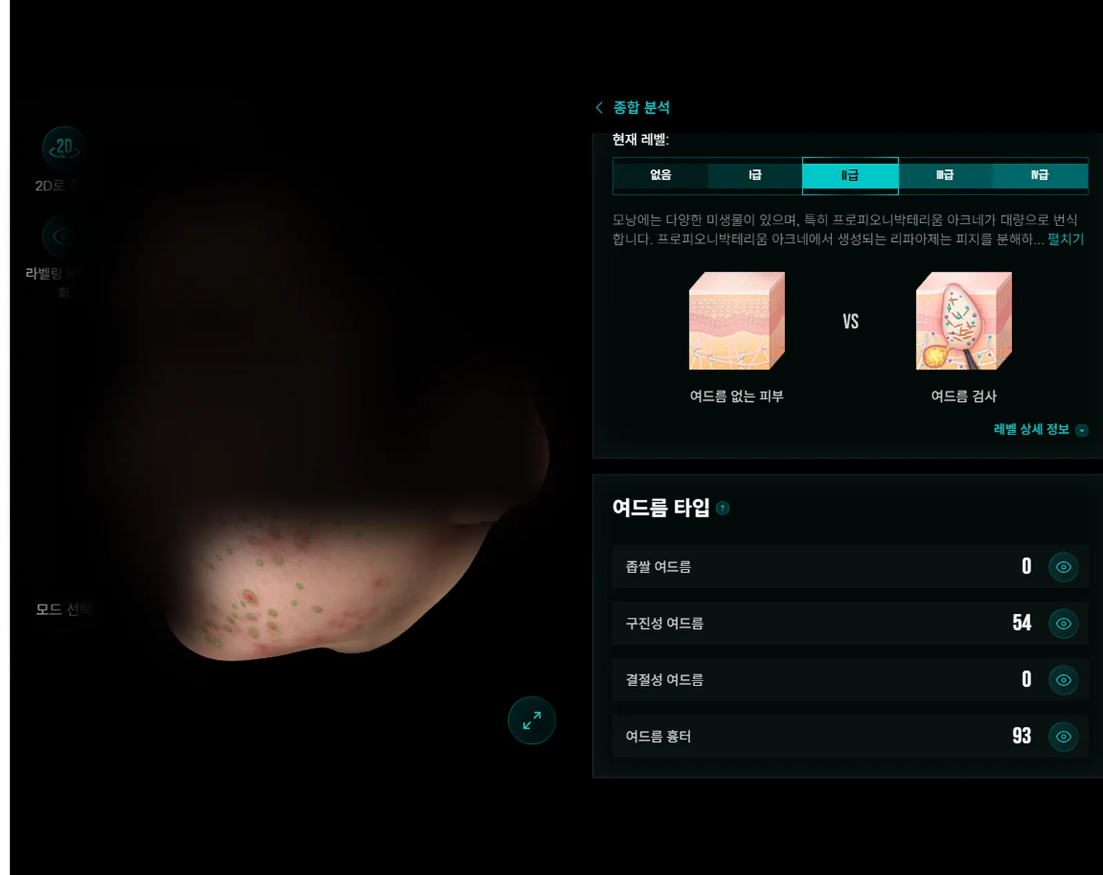 AI 피부분석