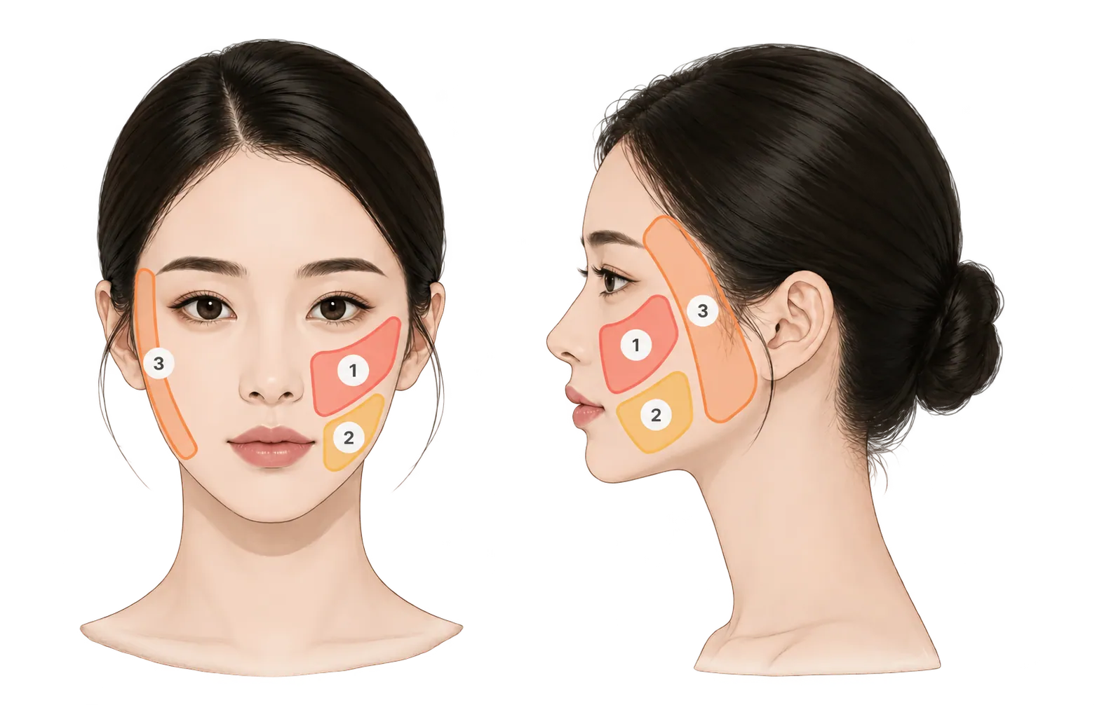 두스실 시술부위: 팔자주름, 마리오네트, 옆볼라인