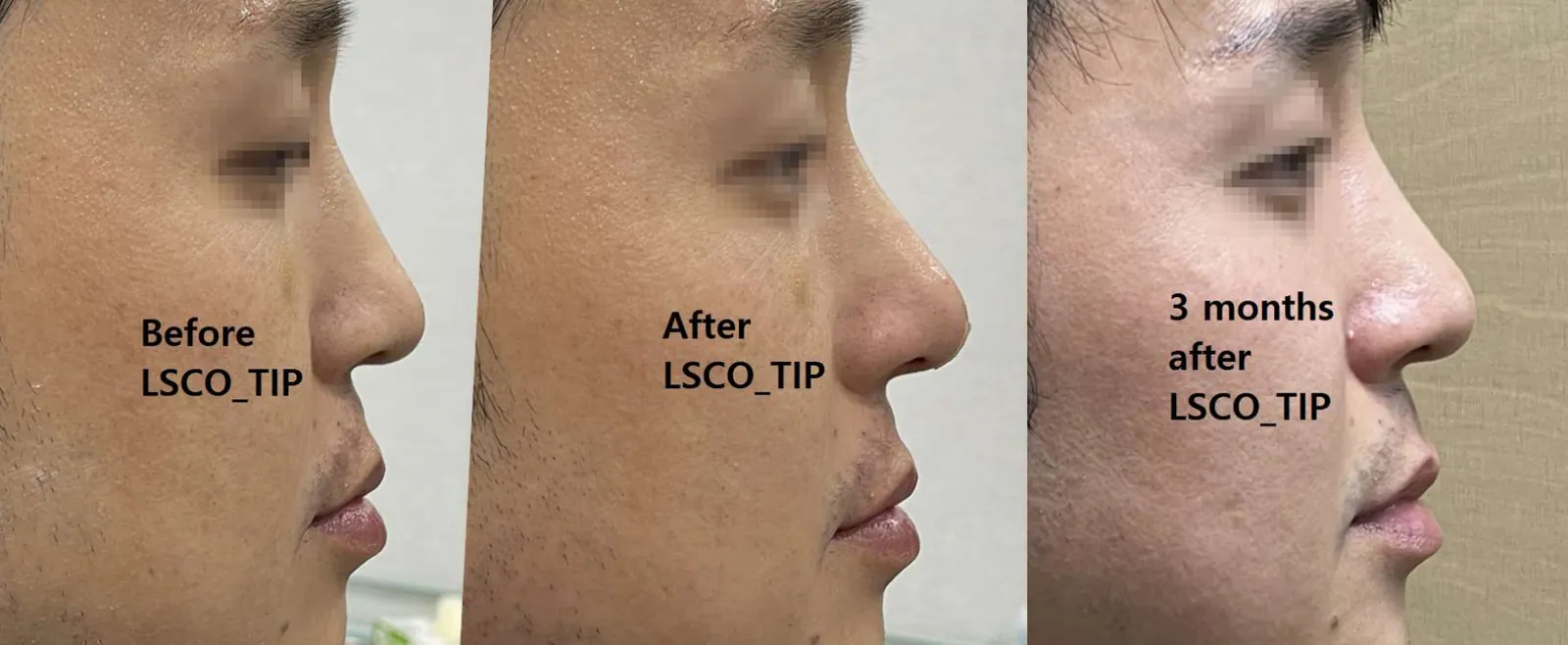 LSCO 코끝 시술 전, 직후, 3개월 후 옆모습 비교 사진