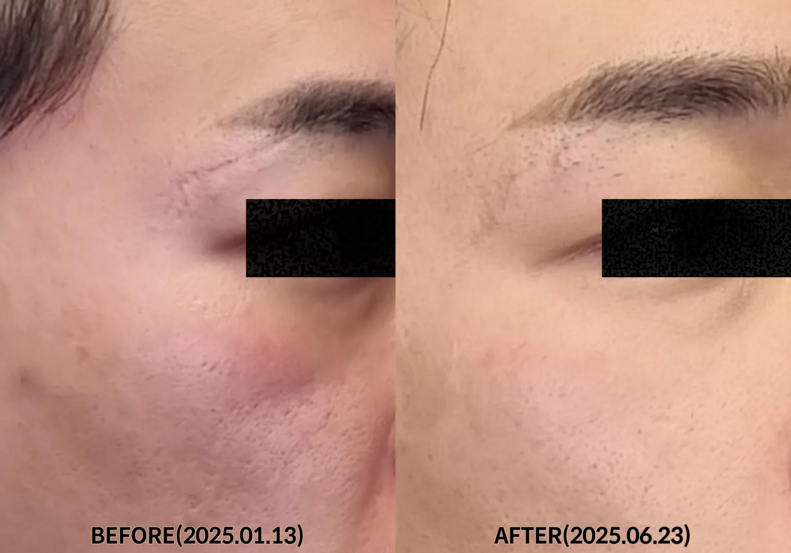 깊은새살테라피 2회 (2025.01 ~ 2025.06) 전후사진