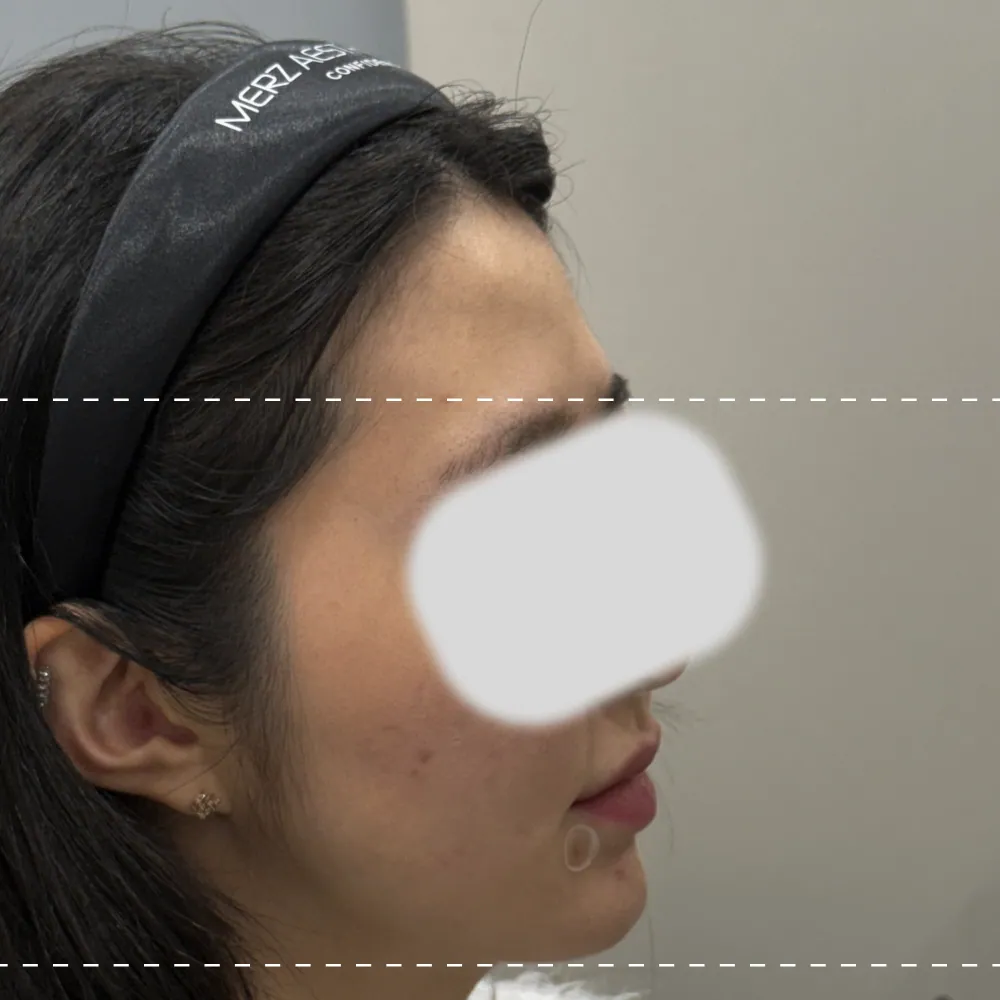 이마필러 오른쪽 90도 시술 전