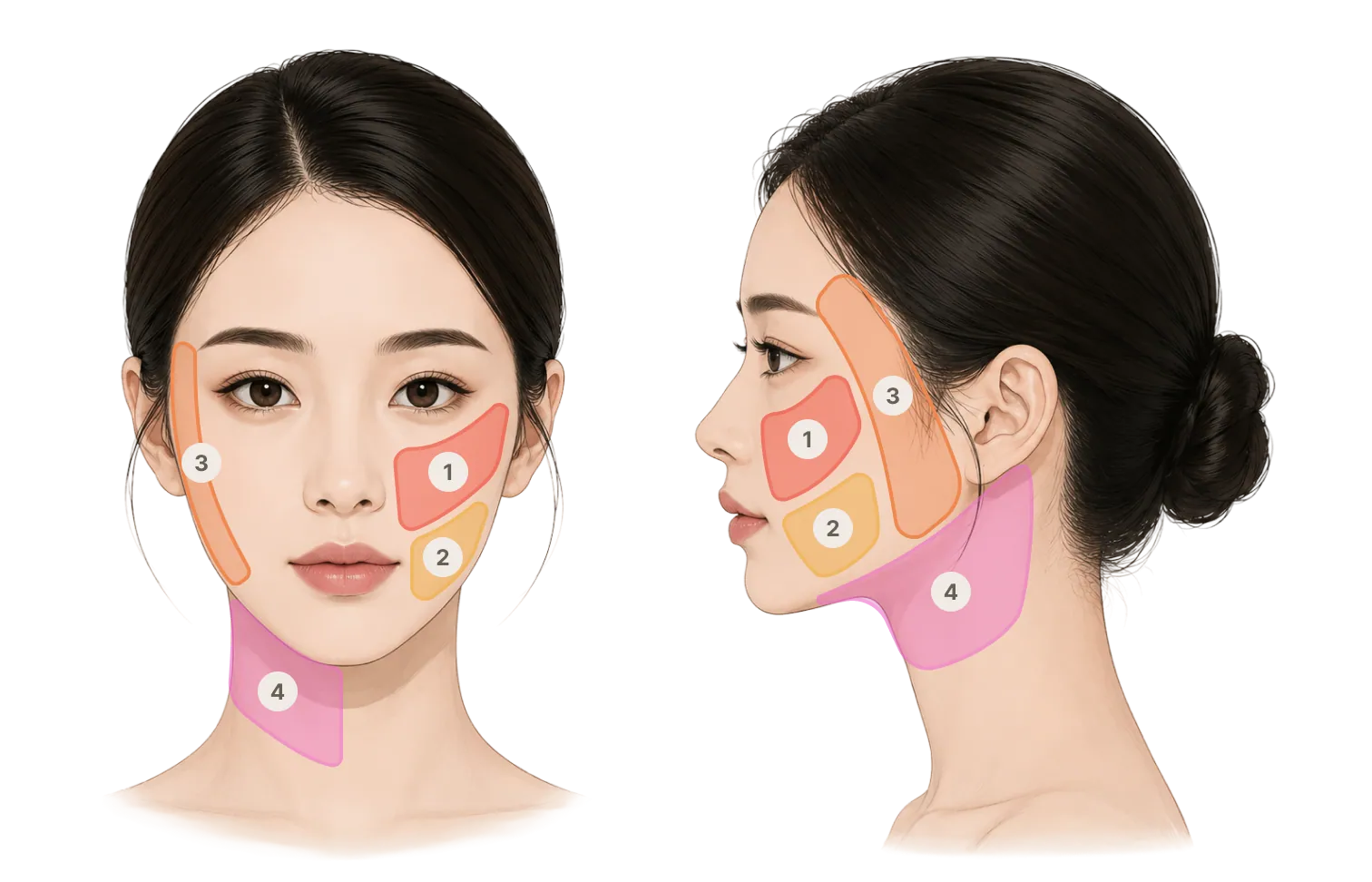 실스컬핑 시술부위