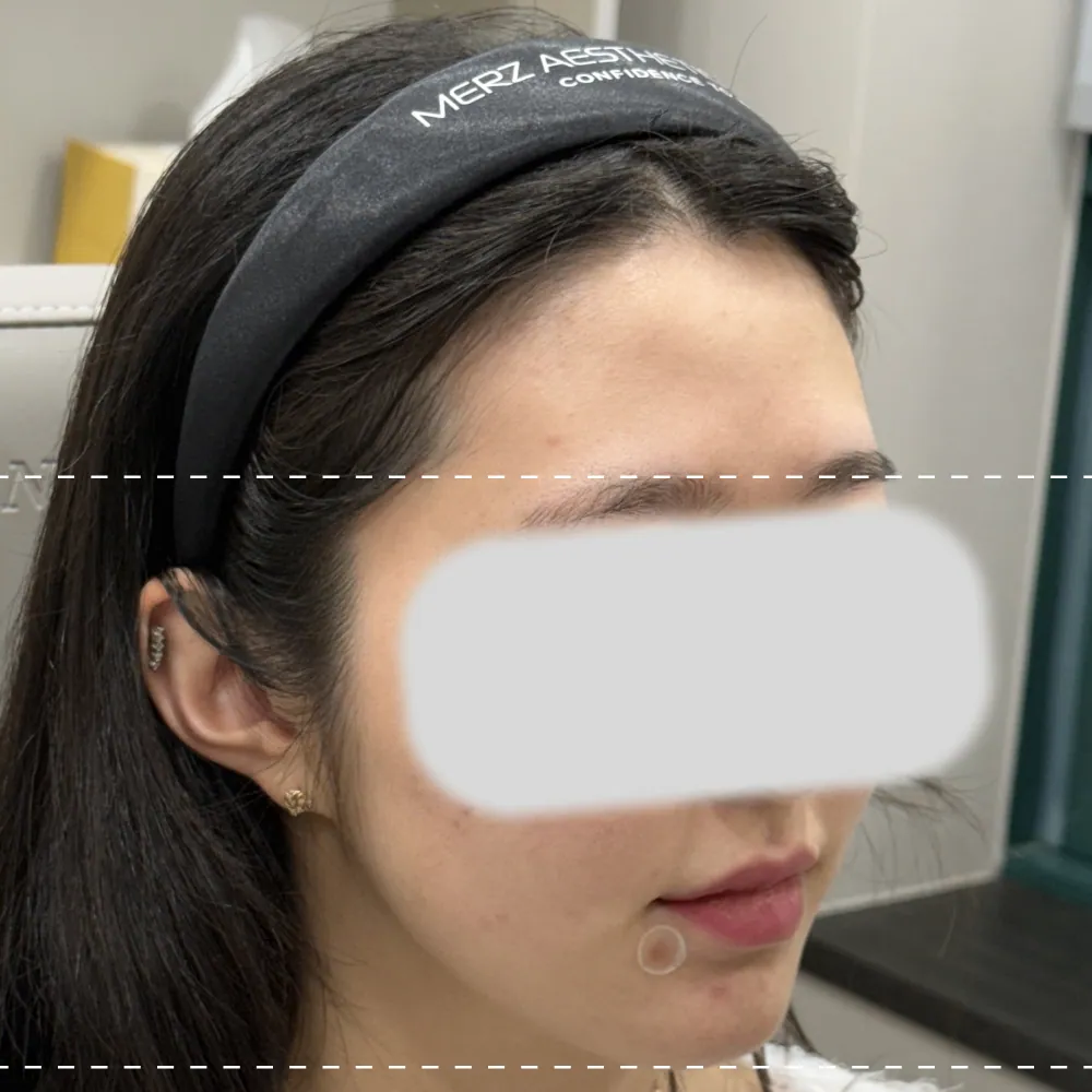 이마필러 오른쪽 45도 시술 전