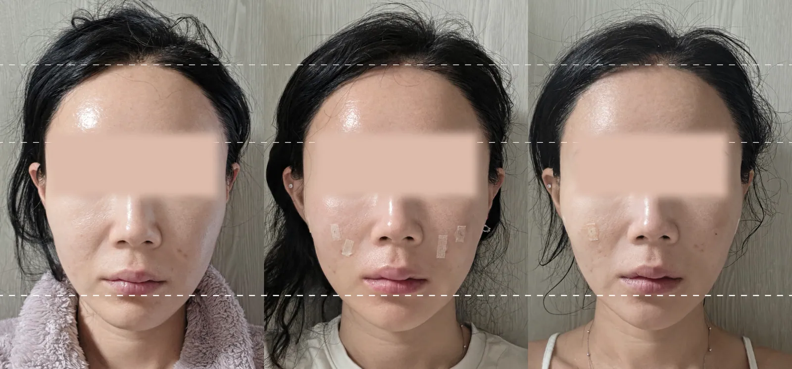 실스컬핑 전후 사진